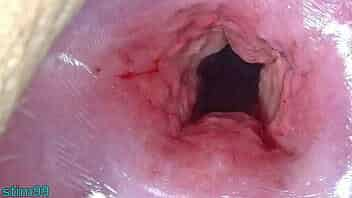 Japan Mom Cervix open wide Dilatation and fucking Uterus with Insertion of huge Objects video